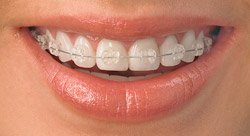 radiance clear braces