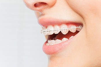 clear braces in dallas texas